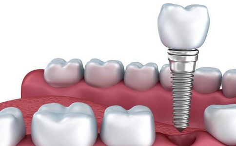 千萬不要隨便做牙齒片切，這些危害和副作用一定要瞭解！
