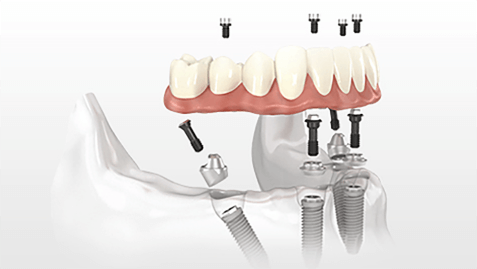 牙齒矯正的效果主要看醫生技術