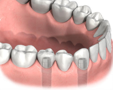 哪些因素會導致種植牙失敗？