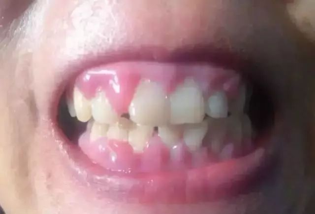 洗牙原來咁多門道？！其實你對洗牙一無所知！