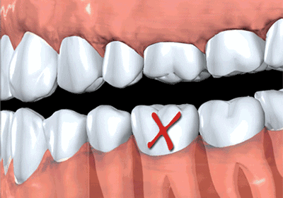 缺牙很久瞭，還有必要種植牙嗎？