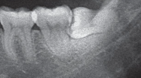 智齒根部阻力分析及操作圖解