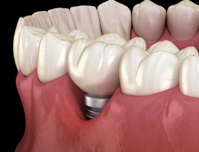 口腔種植牙超詳細介紹，患者再問就用它！