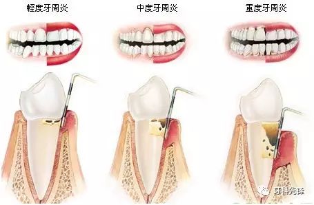 你爲什麽總塞牙......盤點讓你塞牙的四大幕後黑手！