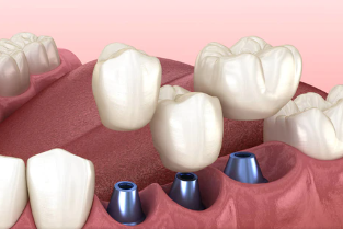 牙槽骨萎縮了還能種牙嗎