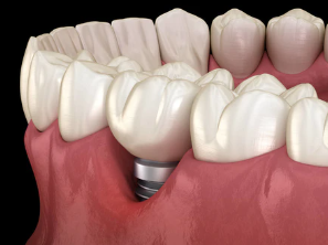 99%的人都塞牙，可是從來沒人重視這個大問題！