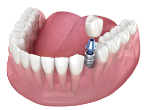種植牙分爲幾種？老年人適合做種植牙嗎？