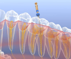 浮雕牙的危害I千萬不要再爲自己的無知而買單！