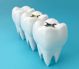 十四條關于樹脂補牙經驗分享