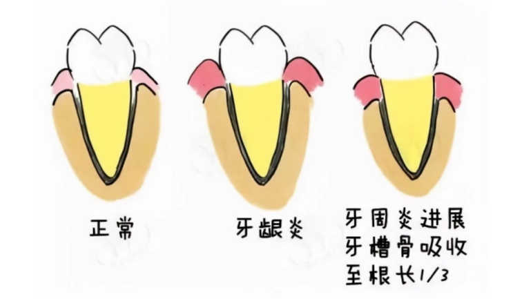 香港種牙人群過半患有牙周病？維港口腔種植牙名家高主任提醒重視牙周健康防治