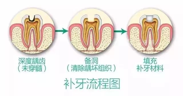 揭秘補牙全過程，你個牙齒到底經歷咗乜嘢？