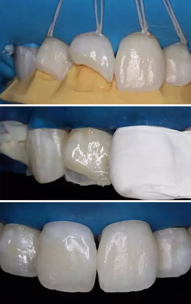做好前牙树脂修复，你需要了解的基本功