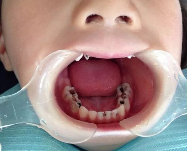 令人心痛！乳牙壞了不管，北京12歲小姑娘最終花了16萬來切除下颌骨！