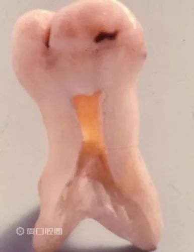 乜嘢係牛牙樣牙