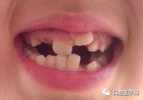 乳牙蛀掉，到底要唔要管？