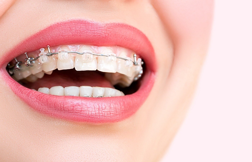 兒童牙齒矯正的黃金時期，你家寶貝錯過了嗎？