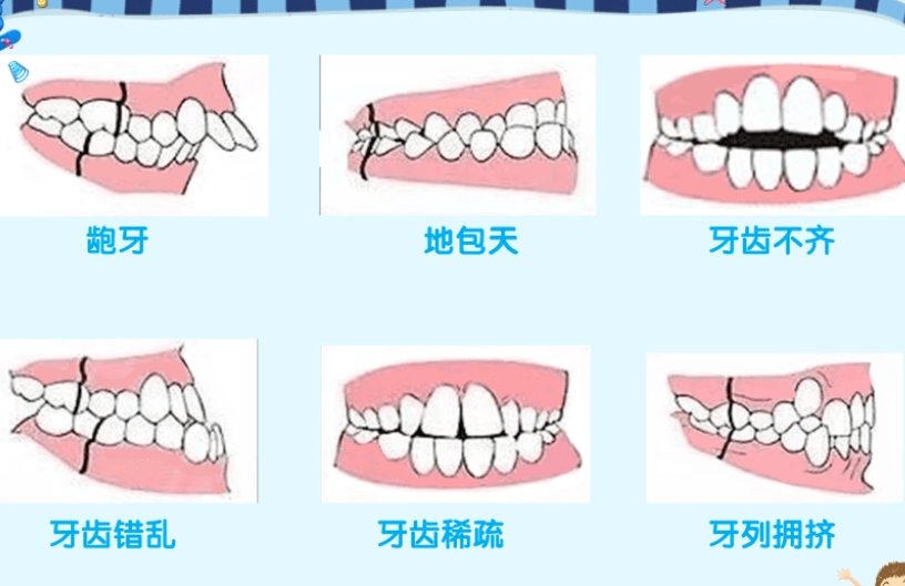 關於牙齒“矯正”，患者嘅最多嘅20個問題！收藏起來