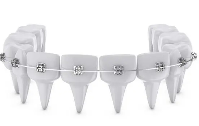 關於牙齒矯正嘅15個祕密！唔看就只能被蒙係牙縫！