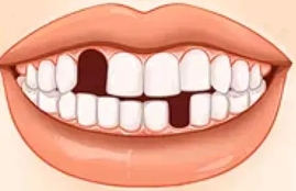 一顆缺失牙齒引起嘅缺憾