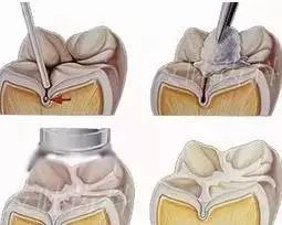 寶寶做窩溝封閉嘅4個最佳時機，你錯過咗未？