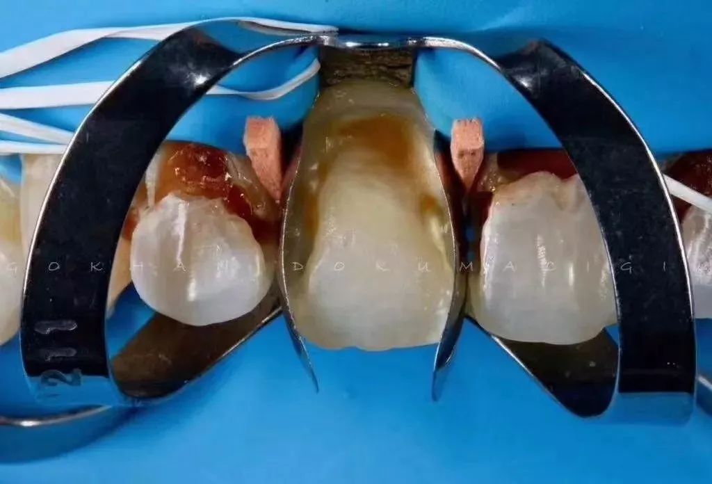 牙齒嘅宿敵--碳酸飲料！！！