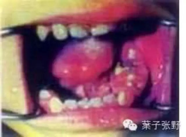 乳牙不治,後果嚴重,不信地呢張牙片