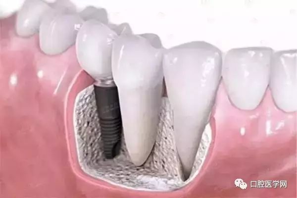 缺牙唔管,後果有多嚴重!