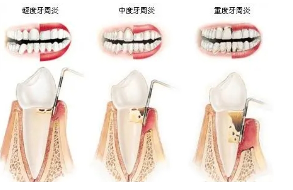 牙周治疗