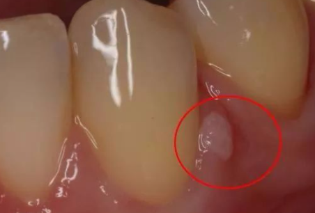 牙齦上長膿包，擠掉後還反覆長出，咩回事？
