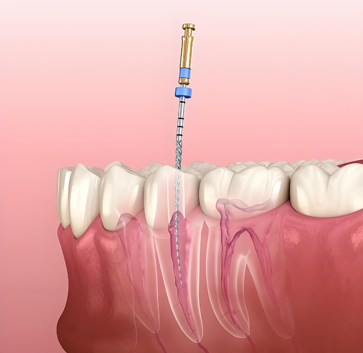 澳門根管治療價格同珠海相差大嗎？
